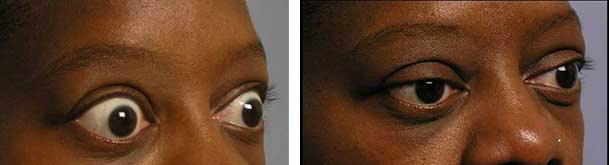 Before (left) and 3-months after (right) bilateral orbital decompression and upper eyelid retraction surgery.