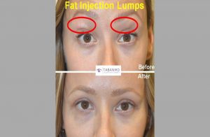 Young mother and model, underwent upper eyelid fat lumps granulomas removal (plus upper blepharoplasty) that had resulted from prior fat injection (fat transfer) by another surgeon. Before and 6 weeks after revision eyelid plastic surgery photos are shown.