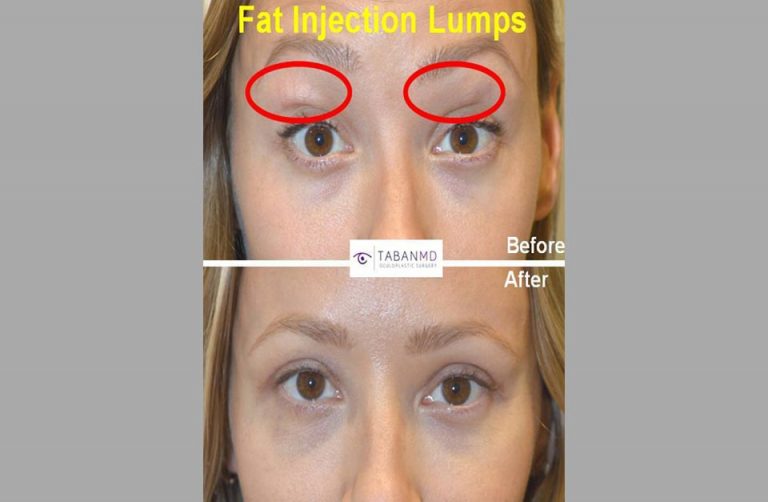 Eyelid And Facial Fat Injection Specialists Los Angeles Ca 
