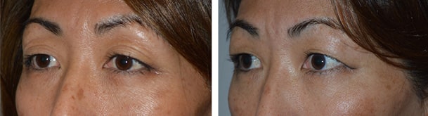 52 Year Old Asian female with fat injection/transfer in upper eyelids and brows, to help stretch the loose saggy skin. Before (left), After (right).