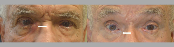 80+ year old male, with severe infection and blockage of right tear drainage duct (dacryocystitis from nasolacrimal duct obstruction) underwent succesful scarless endoscopic right dacryocystorhinostomy (DCR).