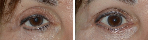 Before (left) Middle age woman with multiple prior eyelid surgeries and blepharoplasty, resulting in right lateral canthal angle distortion and lowering, unnatural right lower eyelid contour, and droopy upper eyelid. After (right) 2 months after revisional eyelid treatment, right canthoplasty, right lower eyelid retraction surgery (internal, with midface lift, without graft) and bottom eye crease contour surgery. Fat injection in upper eyelids.