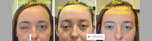 18 year old young brave woman, underwent revision of her right ocular prosthesis (by ocularist) plus right upper eyelid ptosis surgery and right canthoplasty.