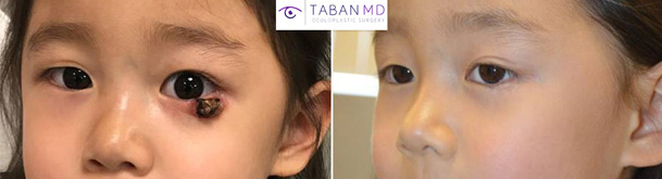 Before and 1 year after reconstructive lower eyelid surgery in a brave young girl with left lower eyelid necrotic lesion.