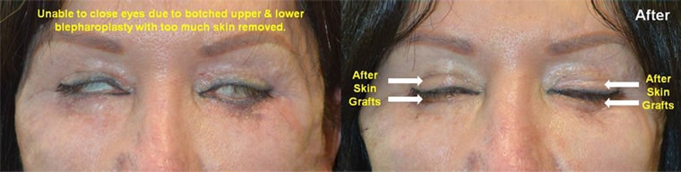 Middle age woman with multiple botched upper and lower blepharoplasty where too much skin was removed with inability to close her eyes. She underwent reconstructive upper and lower eyelid skin graft placement with significant improvement of eye closure and comfort. Before and 2 months after eyelid surgery photos are shown.