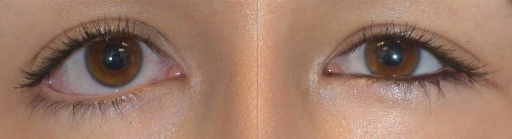 32 year old female, with congenital lower eyelid retraction and canthal dystopia with mongloid slant, underwent Almond Eye Surgery (lower eyelid retraction surgery, soof lift, spacer graft, canthoplasty). Before and 3 months after almond eye surgery photos are shown.
