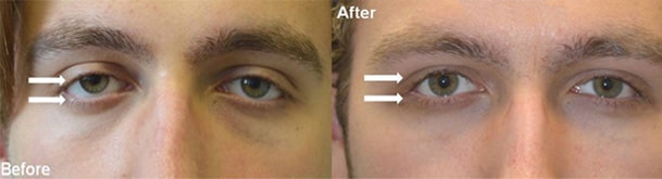 18 year old young man, with congenital droopy lower eyelids with negative canthal tilt and droopy upper eyelids (ptosis), looking sad and tired, underwent lower eyelid retraction surgery with canthoplasty and scarless droopy upper eyelid ptosis surgery. Before and 3 months after eye plastic surgery photos are shown.