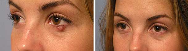Before (left) and one month after (right) eye fold stye treated with kenalog/5FU injection.
