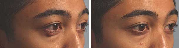 Before (left) and one month after (right photo) of eyelid chalazion drainage.