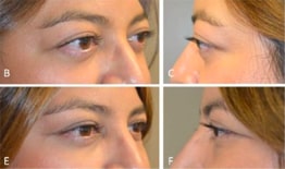 Orbital Decompression and Eyelid Retraction Surgery Before and After Images