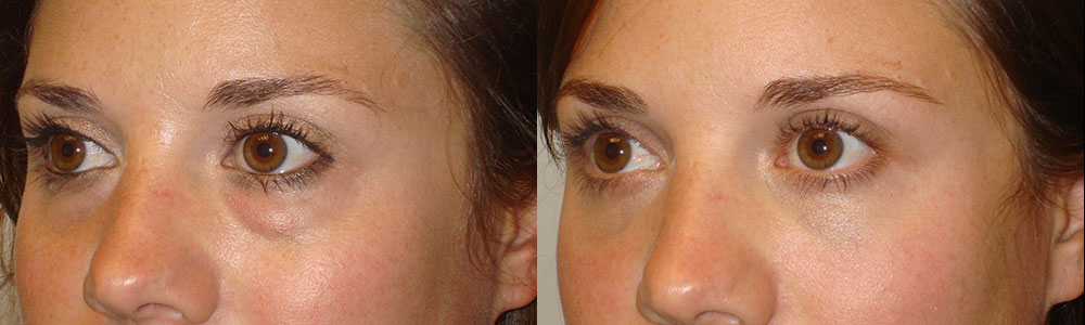 26 year old female, was unhappy about her inherited under eye bags (puffy under eyes, left eye worse), which is due to fat prolapse. She wanted to have more smooth under eye area, without looking hollow. She underwent transconjunctival (stitch-less inside eyelid incision) lower blepharoplasty with fat redistribution, where the bags/fat was repositioned to fill the hollow part below it (tear trough deformity). The procedure was done under local anesthesia in the office. Note improved natural eye appearance, looking more rested. Before and 2 months postoperative photos are shown.
