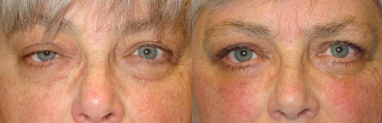 Before eye asymmetry due to right upper eyelid ptosis. After right upper eyelid ptosis repair with improved eye symmetry.