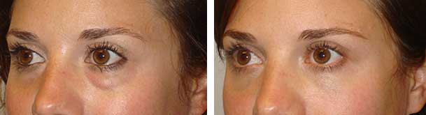 Before (left) and 2 months after (right) transconjunctival lower blepharoplasty with fat repositioning