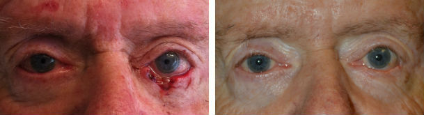 Before (left) lower eyelid cancer after Mohs removal with large defect and 3 months after (right) lower eyelid cancer reconstruction.