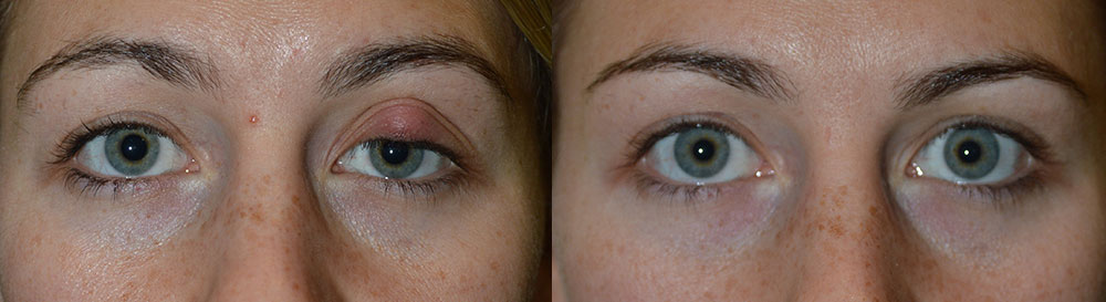 Before (left) Young female, with large left upper eyelid stye (chalazion). Right (after) 1 month after left upper eyelid stye (chalazion).
