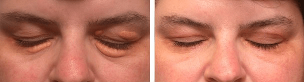 Before (left) and after (right) surgery for large eyelid xanthalasma (eyes closed)