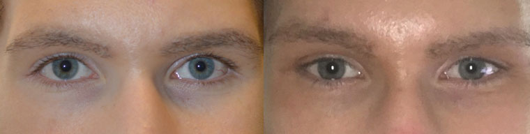 Young male, complained of inherited droopy lower eyelids with sclera show and sad looking eyes. He wanted more almond shape eyes. He underwent lower eyelid retraction surgery (without spacer graft) to create more almond eyes.