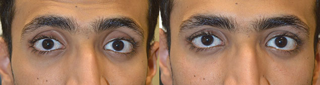 Young man, from Saudi Arabia, complained of sunken hollow eyes and dark circles. He underwent upper eyelid filler and under eye filler injection. Before and immediately after eyelid filler injection photos are shown. Note the improved change in eye shape with less sunken eye appearance.