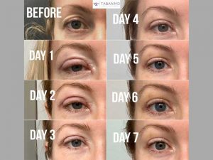 Young woman underwent upper blepharoplasty and upper eyelid filler injection. Note healing during the first week after surgery.