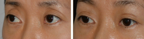 Before (left), prior aggressive upper blepharoplasty resulting in hollow upper eyelids, and 2 months after (right) filler injection in upper eyelid-brow area.