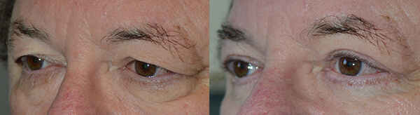 Before (left) and 2 months after (right) cosmetic eyelid surgery including upper blepharoplasty (“eyelid lift” to remove excess skin and tighten muscle) along with lower blepharoplasty (transconjunctival with fat repositioning and skin pinch).