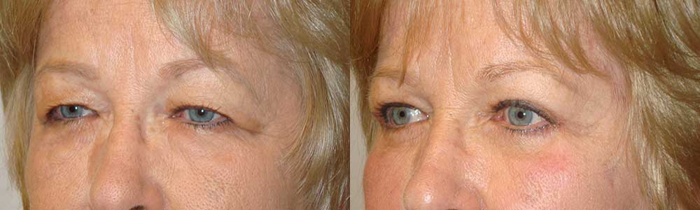 Before (left) and 3 months after (right) bilateral ptosis surgery, upper and lower blepharoplasty, and pretrichial lateral brow lift.