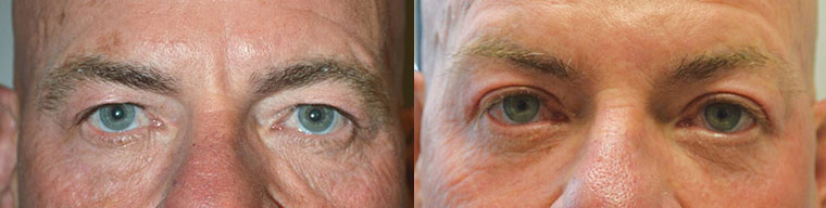 Before (left) and 3 months after (right) cosmetic upper blepharoplasty (skin removal).