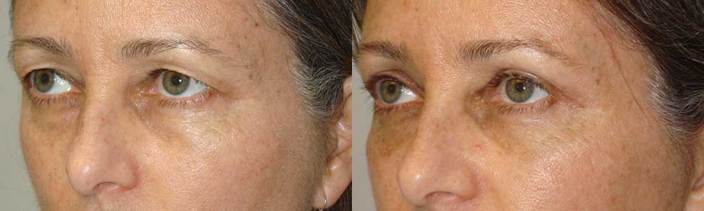 Before (left) and 3 months (after) cosmetic upper blepharoplasty (skin removal) and lateral brow lift (outer brow lifted using temple hairline incision).