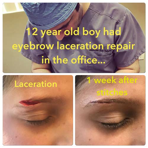 Facial Laceration Repair