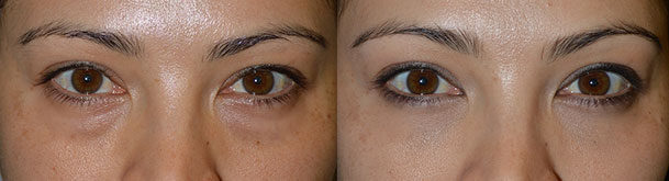 Before (left) and 2 months after (right) cosmetic transconjunctival lower blepharoplasty with fat repositioning (using hidden stitch-less incision inside the lower eyelid, the fat pocket were redistributed to fill the hollow tear trough area) plus conservative skin removal using skin pinch method.