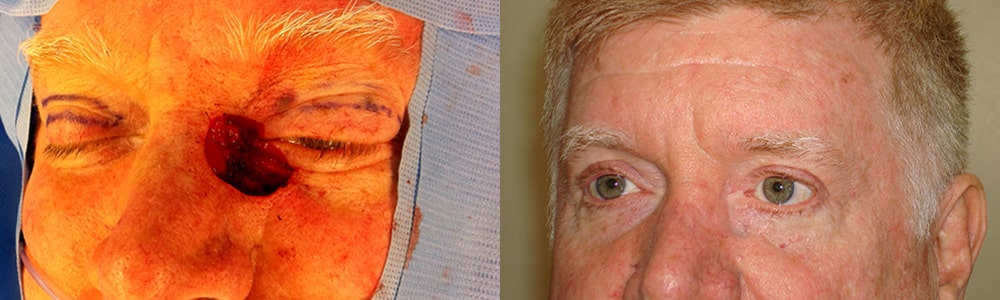 Before (left) 56-year-old male with large eyelid defect following eyelid basal cell carcinoma removal. After (right) reconstruction surgery using multiple flaps for natural-looking results and preserved function.