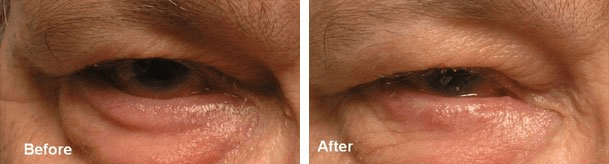 Before (left) and after (right) lower eyelid entropion surgery.