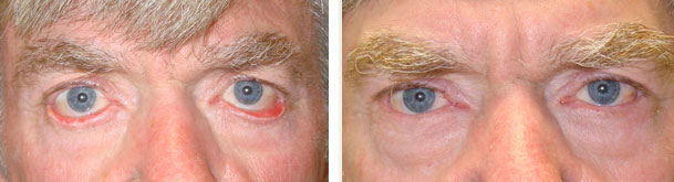 Before (left) and 4 months after (right) lower eye fold ectropion surgery (with switch flap technique, eyelid skin graft).