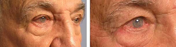 Before (left) and 2 months after (right photo) of right lower eye fold entropion surgery (eyelid turns in).