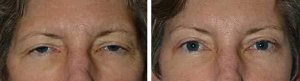 Before (left) and 2-months after (right) endoscopic forehead lift and eyelid ptosis surgery.