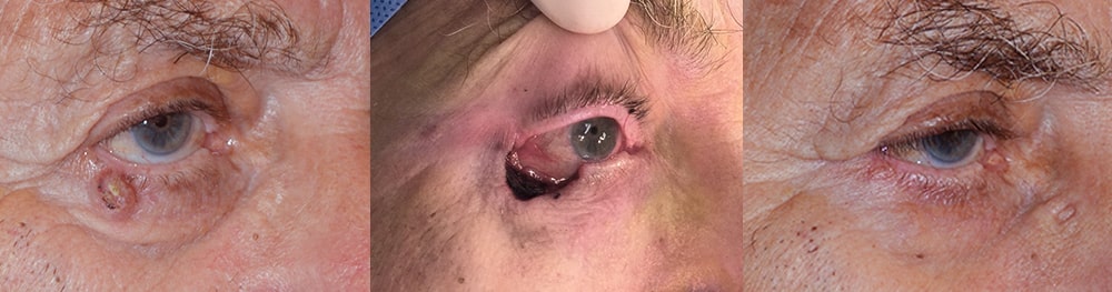 Before (left) 84 year old male with right eye fold basal cell carcinoma. (Middle) Immediately after right lower lid skin cancer removal. After (right) 2 months after right lower eyelid cancer reconstruction.