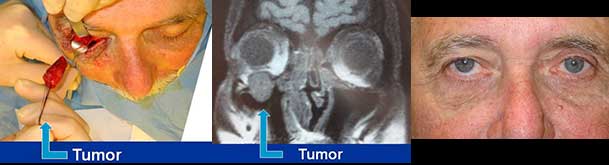 Before (left) and after (right) orbital tumor removal.