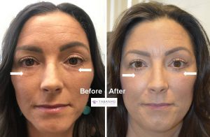47 year old female, with history of fat injection under eyes creating lumps, underwent revision lower blepharoplasty with removal of injected fat lumps and granulomas. Before and 2 months after surgery photos are shown.