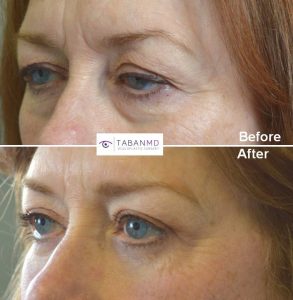 Lower 60+ year old female, looking tired and older, underwent droopy upper eyelid ptosis surgery, upper blepharoplasty (eyelid lift), lower blepharoplasty, and lateral brow lift. Before and 2 months after cosmetic eyelid surgery photos are shown. Note more youthful natural results.
