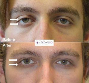 18 year old young man, with congenital droopy lower eyelids with negative canthal tilt and droopy upper eyelids (ptosis), looking sad and tired, underwent lower eyelid retraction surgery with canthoplasty and scarless droopy upper eyelid ptosis surgery. Before and 3 months after eye plastic surgery photos are shown.