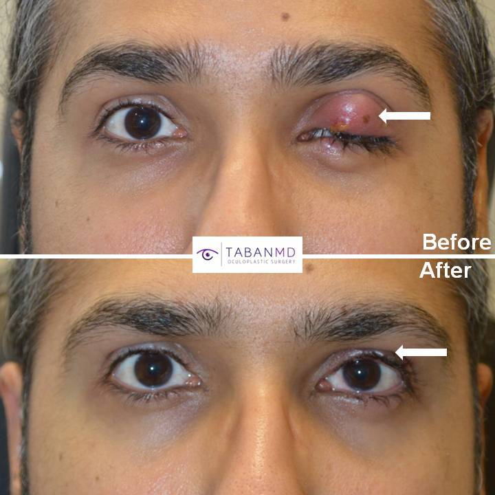 Chalazion Removal Beverly Hills | Stye Surgery Los Angeles