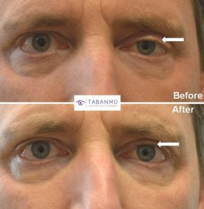 Middle age man underwent scarless left droopy upper eyelid ptosis surgery. Before and 6 weeks after photos are shown.