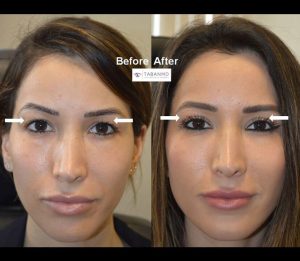 Young beautiful lady with hooded upper eyelids (with skin touching the lashes) underwent upper blepharoplasty (eyelid lift). Before and 2 months after eyelid surgery photos are shown.
