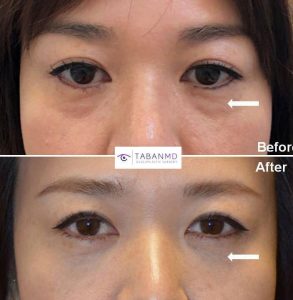 38 year old Asian female, with under eye fat bags and tear trough hollowness, underwent scarless transconjunctival lower blepharoplasty with repositioning of the eye fat bags to the surrounding hollow area, creating more smooth under eyes with natural results. Before and 1 month after lower blepharoplasty photos are shown.
