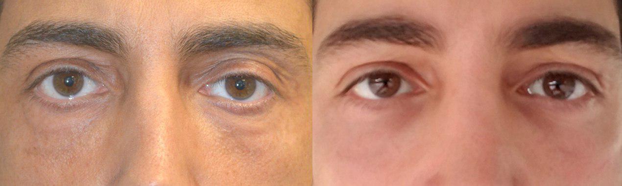 41 year old male, complained of eye asymmetry and looking tired which is due to left upper eyelid ptosis (droopy upper eyelid) and upper eyelid hollowness along with under eye bags. He underwent internal left upper eyelid ptosis surgery and bilateral upper eyelid-brow filler injection, along with transconjunctival lower blepharoplasty with fat repositioning. No skin was removed from any of the eyelids. Before and 6 weeks after cosmetic eyelid surgery and upper eyelid filler injection photos are shown. (After photo is a selfie.)