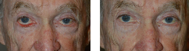 Before (left) After (right) 70 year old male, who underwent right lower eyelid ectropion surgery with skin graft.