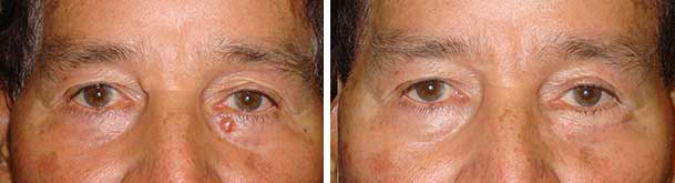 Before (left) and after (right) LEFT lower eye fold basal cell carcinoma resection and reconstruction.
