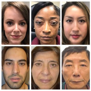 Before/After lower blepharoplasty of mix of patients with different ages, sex, and ethnicity, depicting the benefit of lower blepharoplasty irrespective of those factors.