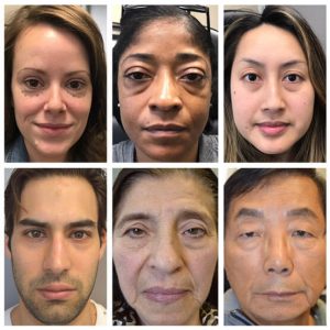 Before/After lower blepharoplasty of mix of patients with different ages, sex, and ethnicity, depicting the benefit of lower blepharoplasty irrespective of those factors.