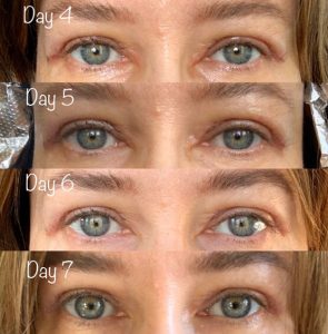 Photos show the average healing of UPPER BLEPHAROPLASTY during the first one of surgery.